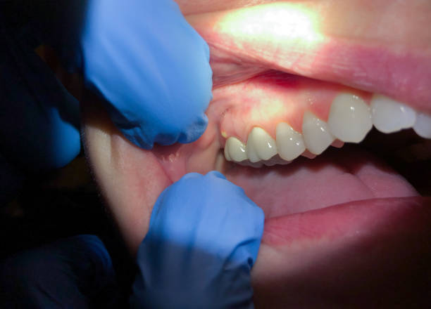 Best Walk-In Emergency Dentist in Morgans Point Resort, TX