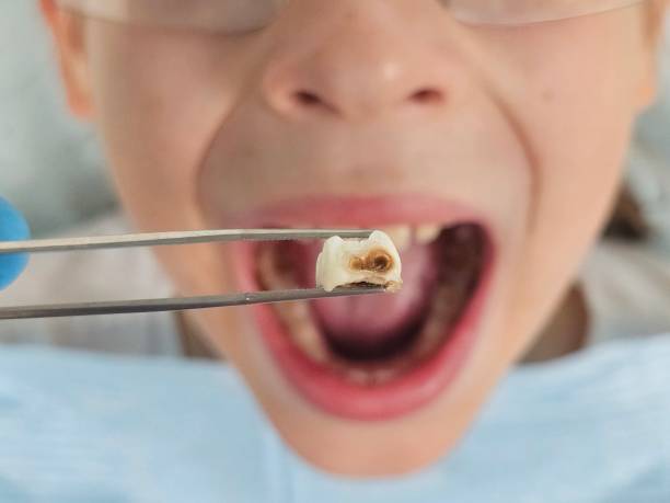 Best Emergency Broken Tooth Repair in Morgans Point Resort, TX